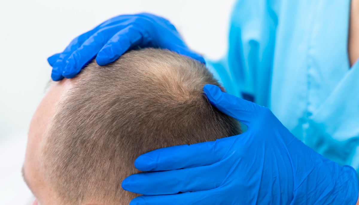 Beyond Finasteride: Why the Future of Hair Restoration Is Biological, Not Pharmaceutical