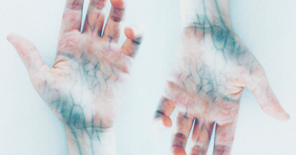 Follistatin: The Body’s Own Anti-Fibrotic Guardian — and What It Means for Scleroderma